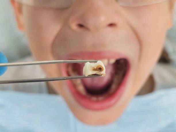 Best Emergency Dental Care for Abscessed Tooth in Kensington Park, FL