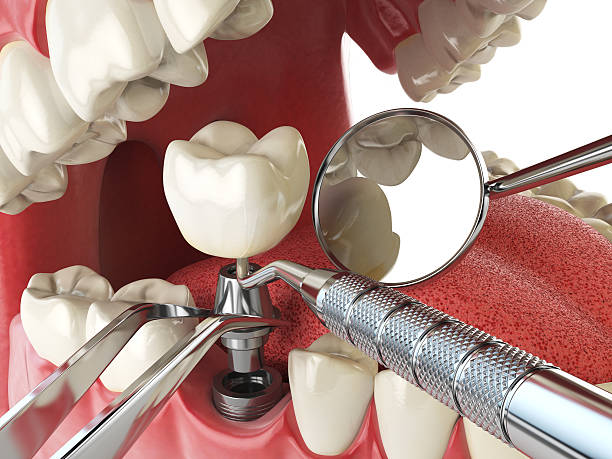 Best Emergency Dental Extractions in Kensington Park, FL